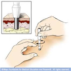 皮肤取样器（皮肤环钻,Skin Biopsy Punches）